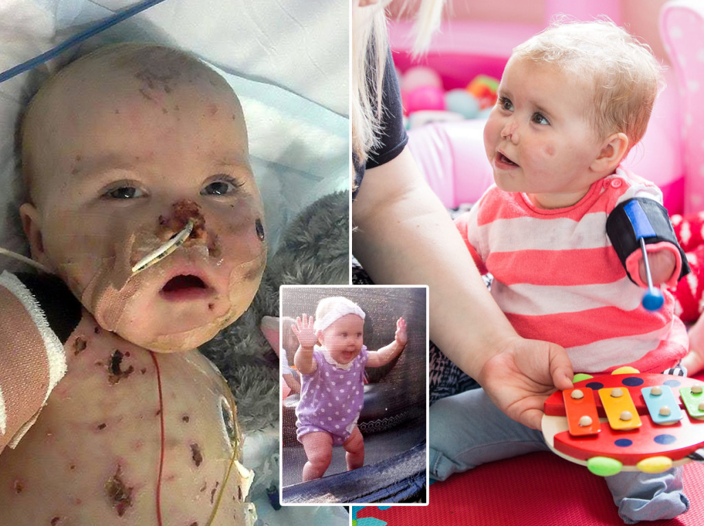 Little Harmonie-Rose Allen pictured in hospital as the brain bug meningitis ravaged her body. See SWNS story SWBATTLE: A heartbreaking collection of images shows just how quickly meningitis took hold of a brave toddler who lost both arms and legs to the disease. Little Harmonie-Rose Allen, one, was struck down with the killer bug just ten days after taking her first faltering steps in September last year. Doctors told her worried parents, Freya Hall and Ross Allen, that it was one of the worst cases of the virus they had even seen and warned she may not pull through. Despite having just a ten per cent chance of survival, Harmonie, from Bath, Somerset, proved doctors wrong by fighting off the illness.
