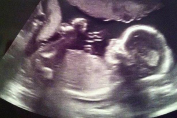 Woman-finds-angel-in-baby-scan