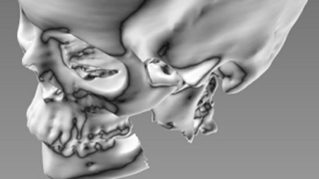 Csont-, izom- és porcdarabokat nyomtattak 3D-ben amerikai orvosok