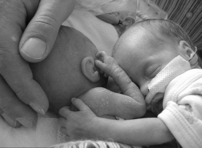 Ikertestvére ölelése hozta vissza az életbe a haldokló koraszülött babát