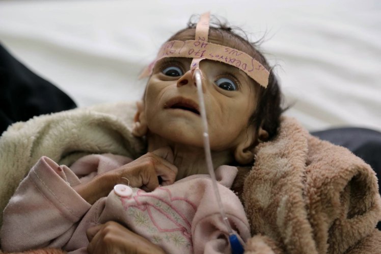 In this Tuesday, March 22, 2016 photo, infant Udai Faisal, who is suffering from acute malnutrition, is hospitalized at Al-Sabeen Hospital in Sanaa, Yemen. Udai died on March 24. Hunger has been the most horrific consequence of Yemenís conflict and has spiraled since Saudi Arabia and its allies, backed by the U.S., launched a campaign of airstrikes and a naval blockade a year ago. (AP Photo/Maad al-Zikry)