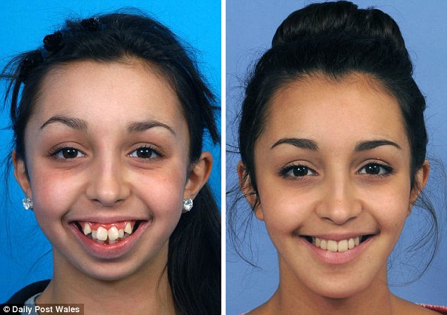 Csodaszép lett a beteg lány, aki megműttette deformált állkapcsát és fogait