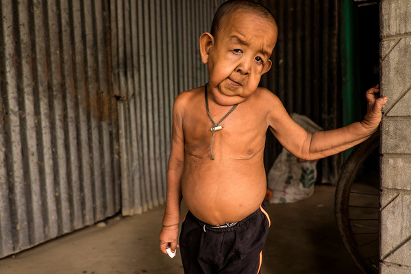 4 year-old boy who looks liek an 80 year-old, from Bangladesh