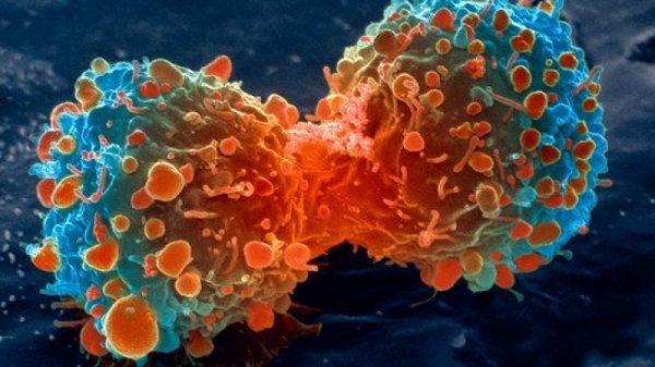 Jelentősen javultak a rákbetegek túlélési esélyei Nagy-Britanniában