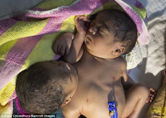 39677B3900000578-3839628-The_case_follows_soon_after_another_set_of_conjoined_twins_were_-a-88_1476540822407