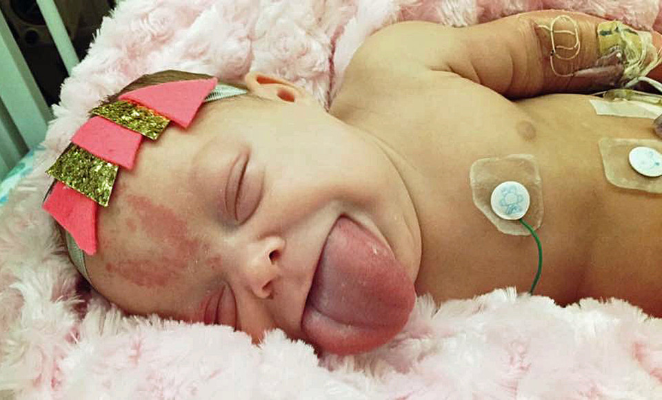 PICS BY MADISON KIENOW / CATERS NEWS - (PICTURED: Here you can see Paisleys massive tongue, at six months she would have the first of two reduction surgeries to ensure she didnt choke to death) - A baby born with a massive adult-sized tongue has finally been able to smile for the first time after life-changing surgery. Paisley, from Aberdeen in South Dakota, USA, had such a large tongue that she needed breathing apparatus for the first week of her life to stop her from choking to death. She was born with Beckwith Wiedemann Syndrome (BWS) an overgrowth disorder that affects one in every 11,000 births worldwide. The rare condition caused the little girls tongue to grow more than twice the size of her mouth and it even shocked doctors, who said it was one of the largest tongues they had ever seen. Until she was six months old, Paisley had to be fed via by a gastronomy-tube because she struggled to eat and wasnt receiving the vital nutrients needed to keep her alive. - SEE CATERS COPY